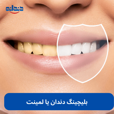 بلیچینگ دندان یا لمینت؟ یک دو راهیِ شک برانگیز!